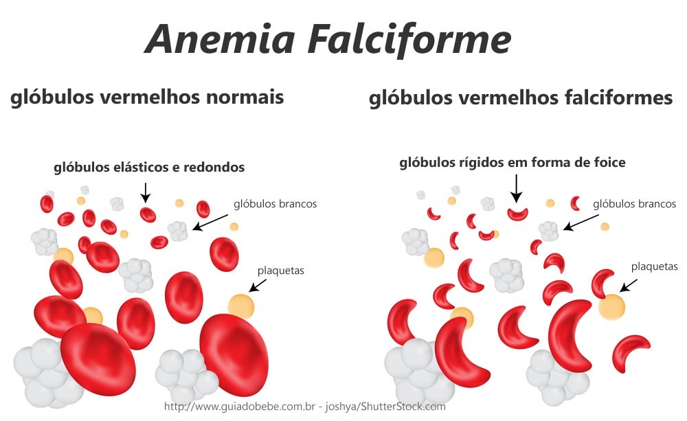 Ilustração de glóbulos vermelhos com anemia falciforme - foto: joshya/ShutterStock.com
