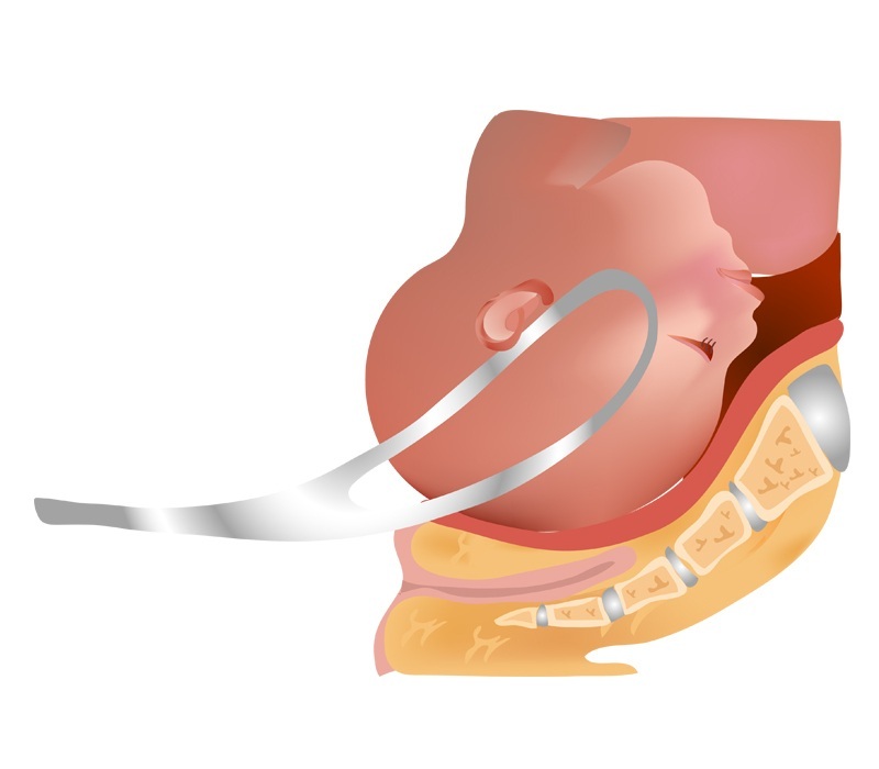 Ilustração mostrando a posição da pinça para a retirada do bebê (parto fórceps) - foto: shna/ShutterStock.com