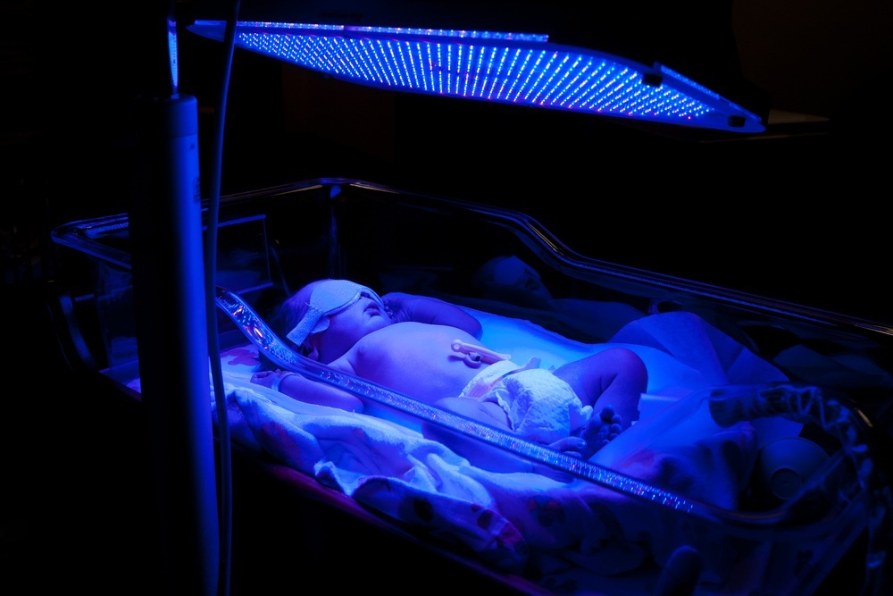 Bebê recém-nascido com icterícia recebendo banho de luz UV para fototerapia - foto: Paul Hakimata Photography/ShutterStock.com Bebê recém-nascido com icterícia recebendo banho de luz UV para fototerapia - foto: Paul Hakimata Photography/ShutterStock.com