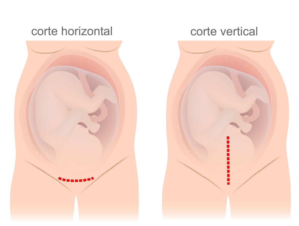 Tipos de incisões para um parto cesariano - foto: Alila Medical Media/ShutterStock.com