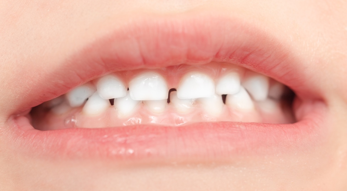 Criança com boca semi-aberta mostrando os dentes - foto: schankz/ShutterStock.com