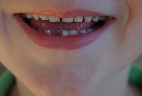 Fluorose dental - Foto: bigbear / pixabay.com
