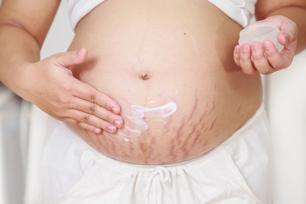 Mulher grávida passando creme sobre a pele com estrias - foto: baipooh/ShutterStock.com Mulher grávida passando creme sobre a pele com estrias - foto: baipooh/ShutterStock.com