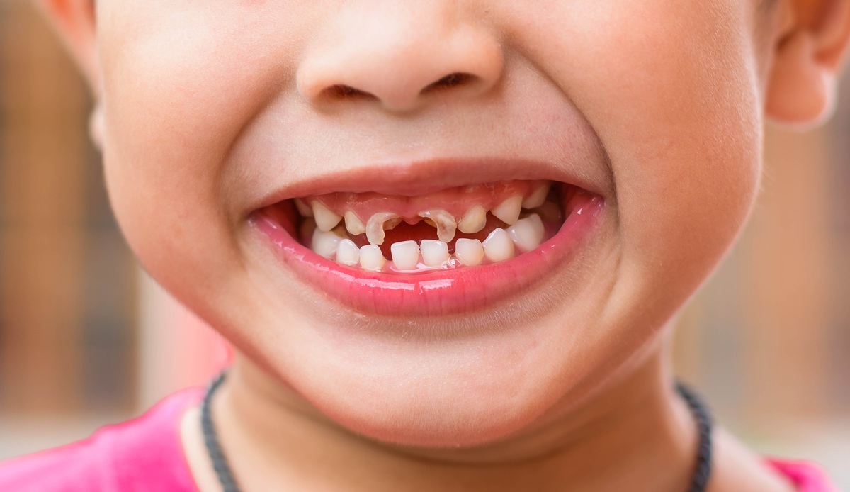 Criança sorrindo com os dentes cariados - foto: Tewan Banditrukkanka/ShutterStock.com