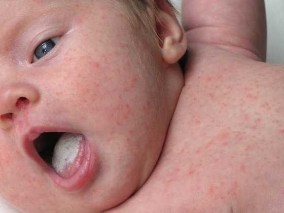 Bebê apresentando manchas vermelhas na pele - foto: Glamorous Images/ShutterStock.com
