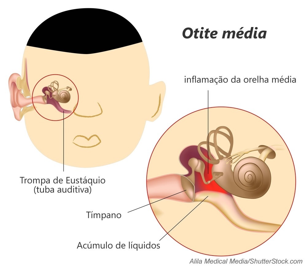 Otite média - foto: Alila Medical Media/ShutterStock.com Otite média - foto: Alila Medical Media/ShutterStock.com